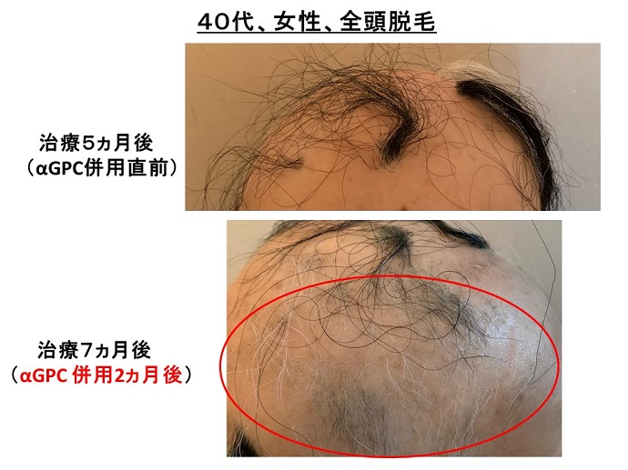 円形脱毛症　病院
